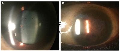 Ophthalmic implications of biological threat agents according to the chemical, biological, radiological, nuclear, and explosives framework